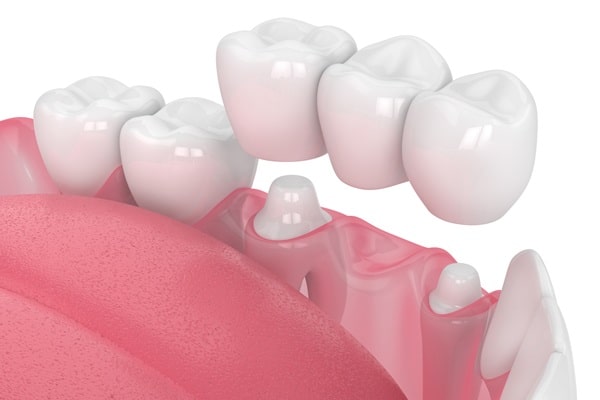 dental-bridges-willow-point-dental-clinic