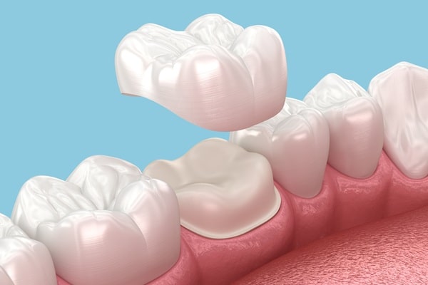 dental-crowns-willow-point-dental-clinic