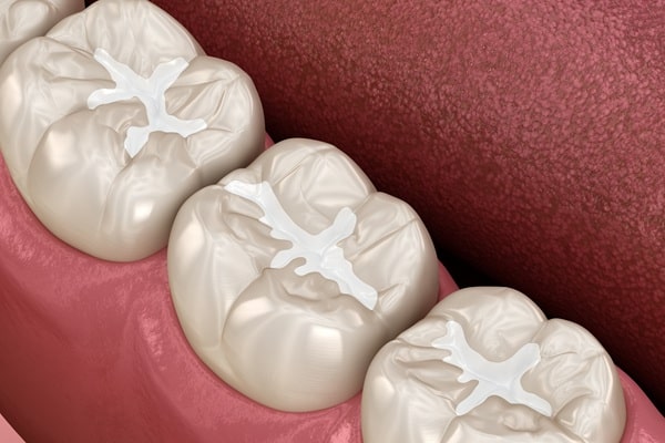 dental-fillings-willow-point-dental-clinic