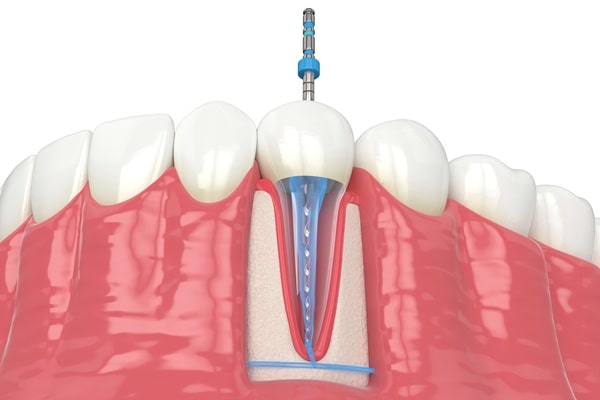 endodontics-willow-point-dental-clinic