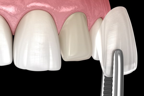 veneers-willow-point-dental-clinic